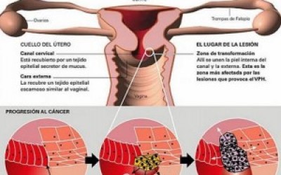 cancer-oral-300x241