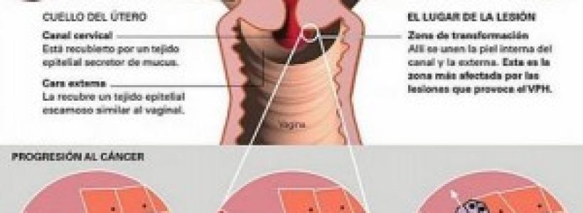 cancer-oral-300x241