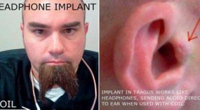 hombreseimplantaaudifonosenlasorejas