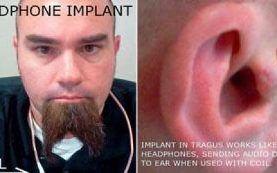 hombreseimplantaaudifonosenlasorejas