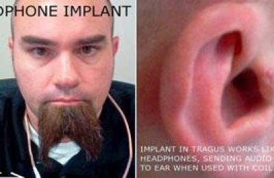 hombreseimplantaaudifonosenlasorejas