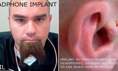 hombreseimplantaaudifonosenlasorejas
