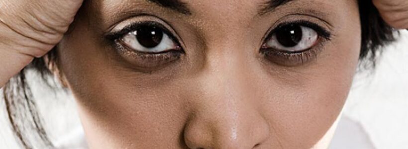 ojeras_2
