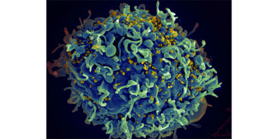 HIV_AIDS