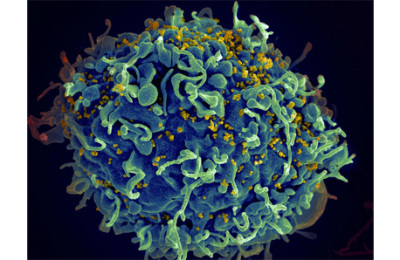 HIV_AIDS