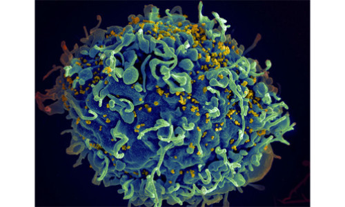 HIV_AIDS