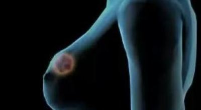 detector_casero_de_cancer_de_mama