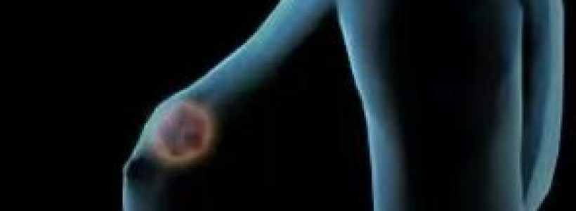 detector_casero_de_cancer_de_mama