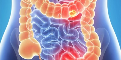 CancerColon1-500x325