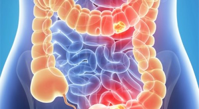 CancerColon1-500x325