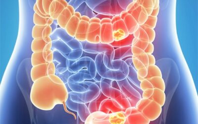 CancerColon1-500x325