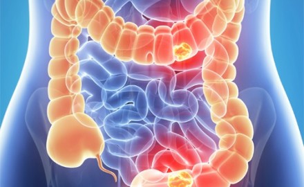 CancerColon1-500x325