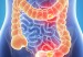 CancerColon1-500x325