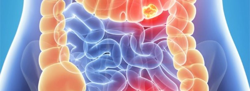 CancerColon1-500x325