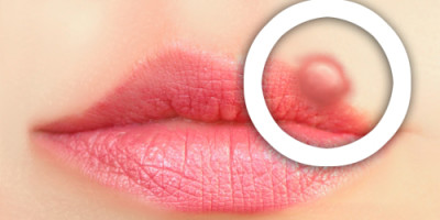 Herpes-Labial