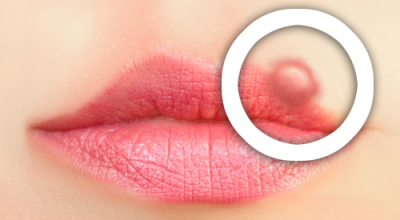 Herpes-Labial