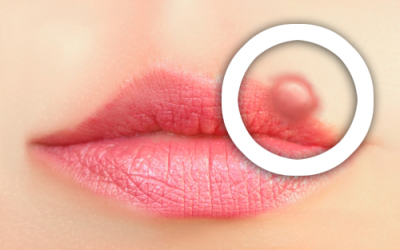 Herpes-Labial