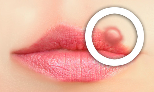 Herpes-Labial