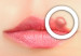 Herpes-Labial