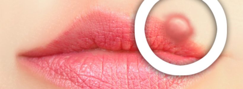 Herpes-Labial