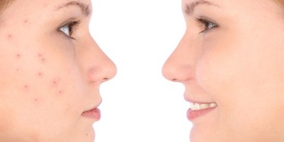 Acne-500x325