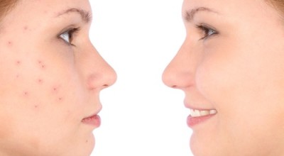 Acne-500x325