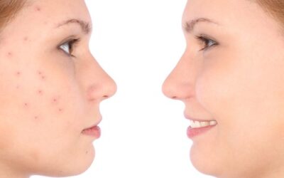 Acne-500x325