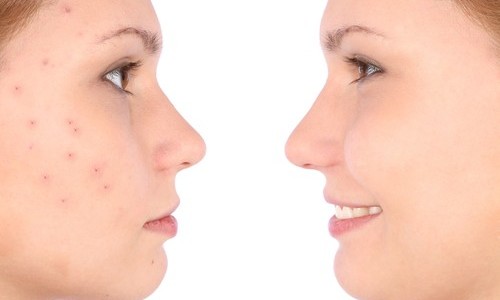 Acne-500x325
