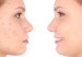 Acne-500x325