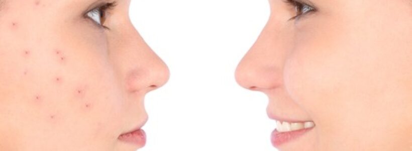 Acne-500x325